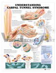 Understanding Carpal Tunnel Syndrome Anatomical Chart